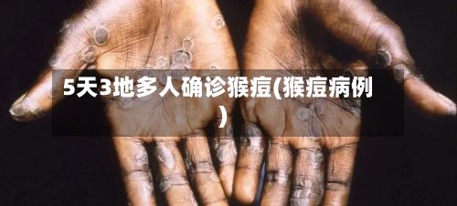 5天3地多人确诊猴痘(猴痘病例)
