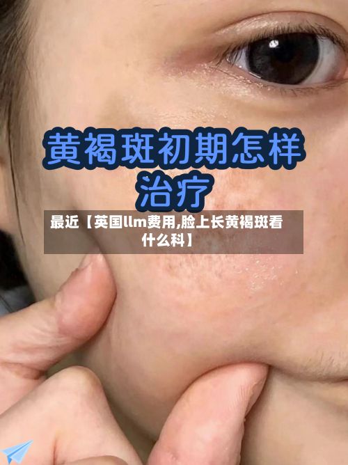 最近【英国llm费用,脸上长黄褐斑看什么科】