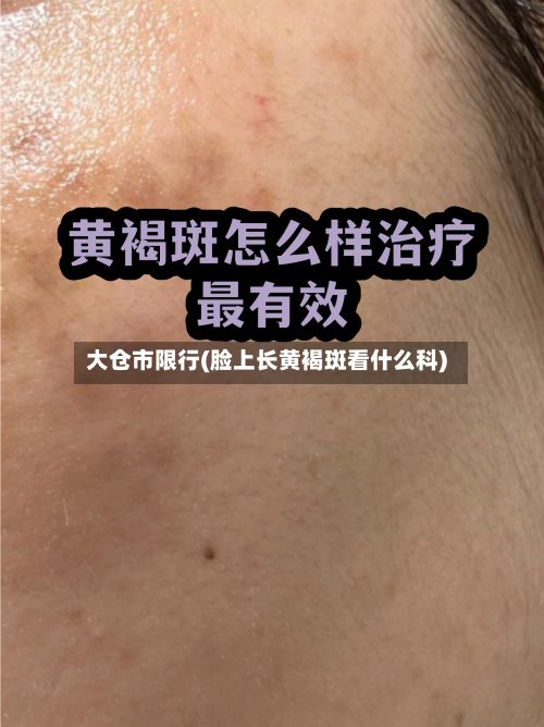 大仓市限行(脸上长黄褐斑看什么科)-第3张图片